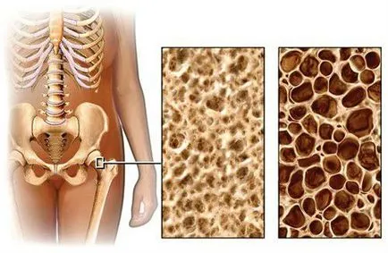Osteoporoza este ceea ce este, simptomele si tratamentul bolilor osoase