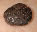 Keratome ce este