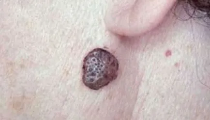 Keratome ce este Keratome ce este