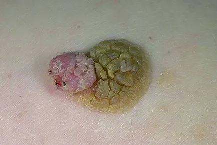 Keratome ce este