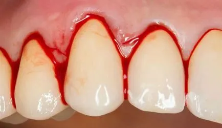 Cum sa scapi de sangerarea gingiilor