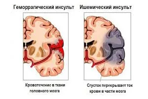 Reabilitare după accident vascular cerebral la domiciliu Reabilitare după accident vascular cerebral la domiciliu