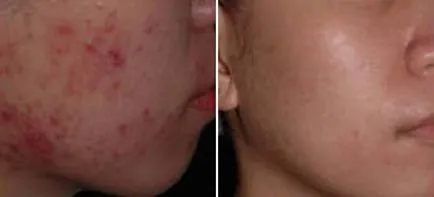 Tratamentul cu laser de acnee