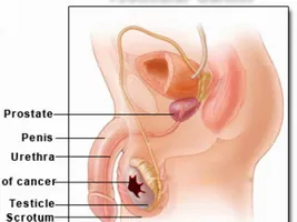 Ce ajutor de la prostatita