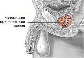 Ce ajutor de la prostatita