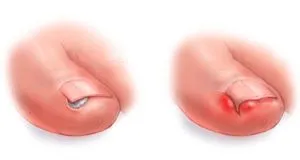 Un abces pe tratamentul deget de la picior Un abces pe tratamentul deget de la picior