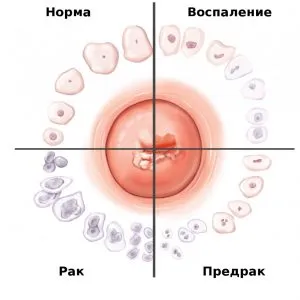 Cum pot trata eroziunea Cum pot trata eroziunea
