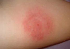 Umflătură de la muscatura tratamentului musculițe decât îndepărtat și tratat, mijloace (casnice)