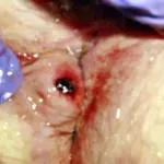 tratamentul chirurgical