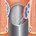 tratamentul chirurgical