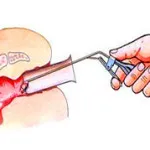 tratamentul chirurgical