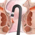 tratamentul chirurgical