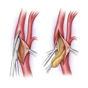 tratamentul chirurgical