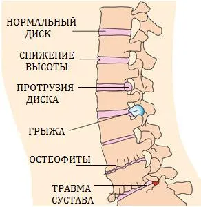Care sunt semnele osteocondrozei
