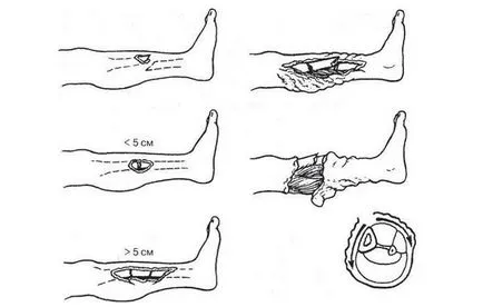 Care sunt semnele osteocondrozei
