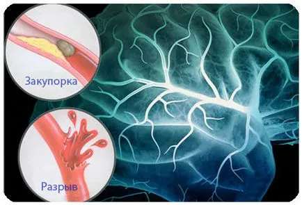 Cerebral tratament tulburări circulatorii