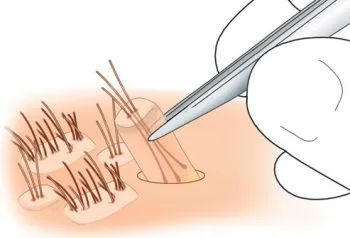 Cum să transplant de păr