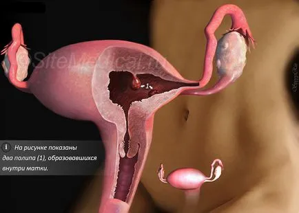 Hysteroresectoscopy ce este Hysteroresectoscopy ce este