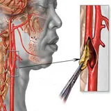 un al doilea accident vascular cerebral