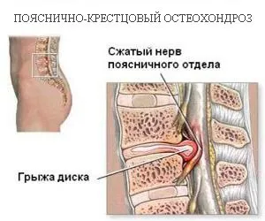Tratamentul coloanei vertebrale lombare sacral