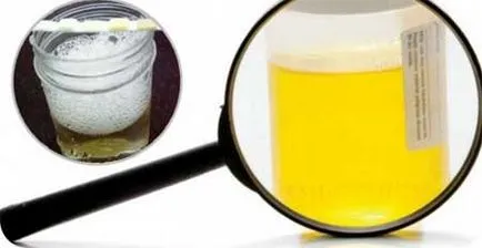 O mulțime de proteine în urină, care este O mulțime de proteine în urină, care este