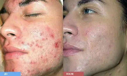Tratamentul cu laser de acnee