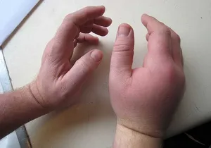Pe ce mâinile inflamat Pe ce mâinile inflamat