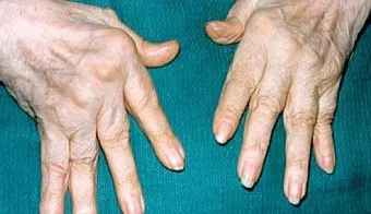 Pe ce mâinile inflamat Pe ce mâinile inflamat