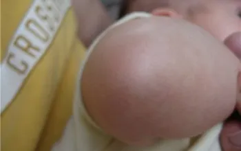 Un copil în coate ca o erupție cutanată