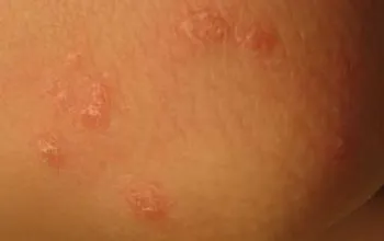 Un copil în coate ca o erupție cutanată
