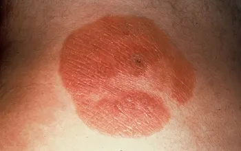 Un copil în coate ca o erupție cutanată