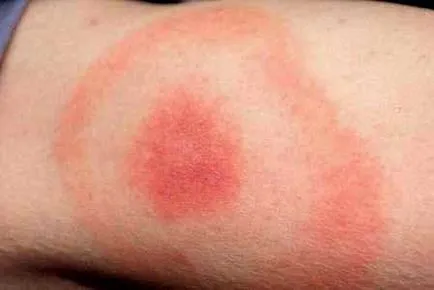 Cum de a determina mușcătura de căpușă Cum de a determina mușcătura de căpușă