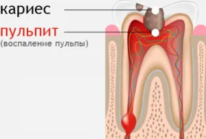 Care este tratamentul pulpitei