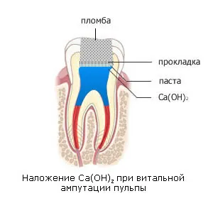Care este tratamentul pulpitei
