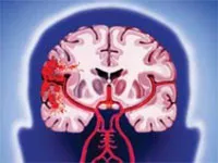Accident vascular cerebral la barbati