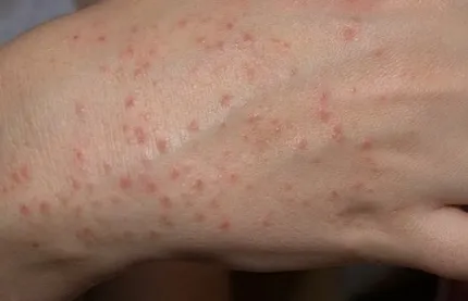 Din acel cosuri erupții cutanate