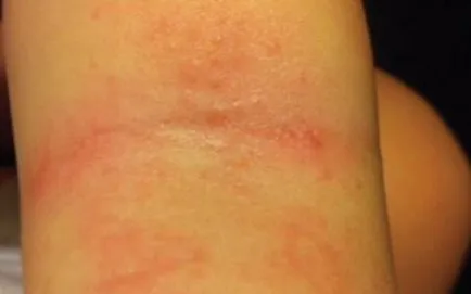 Un copil în coate ca o erupție cutanată Un copil în coate ca o erupție cutanată