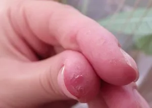 De atunci exfolia pielea de pe mâini De atunci exfolia pielea de pe mâini