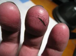 De atunci exfolia pielea de pe mâini De atunci exfolia pielea de pe mâini