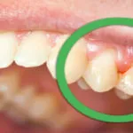 Cum sa scapi de sangerarea gingiilor
