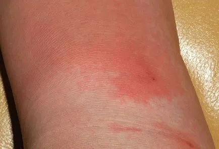 infecție streptococică la copii infecție streptococică la copii