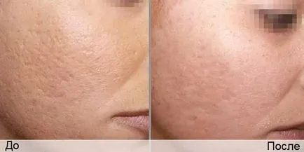Tratamentul cu laser de acnee