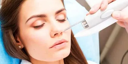 Tratamentul cu laser de acnee