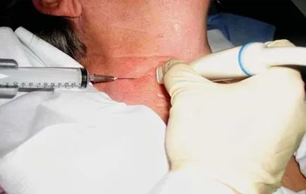 biopsie ac a glandei tiroide