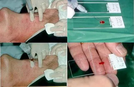 biopsie ac a glandei tiroide