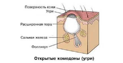 Acnee pe fata la domiciliu Acnee pe fata la domiciliu