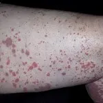 vasculita-l vasculita-l