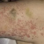 vasculita-l vasculita-l