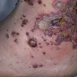 vasculita-l vasculita-l