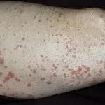 vasculita-l vasculita-l